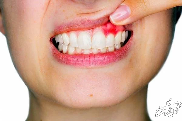 دندان در بر اثر التهاب لثه التهاب لثه